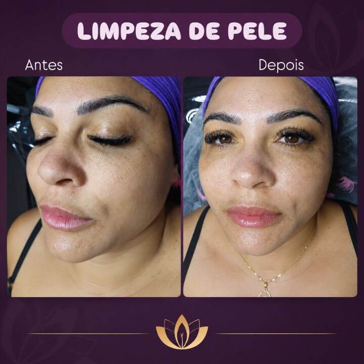 Resultado de limpeza de pele no Studio Flávia Demétrio Estética e Bem Estar