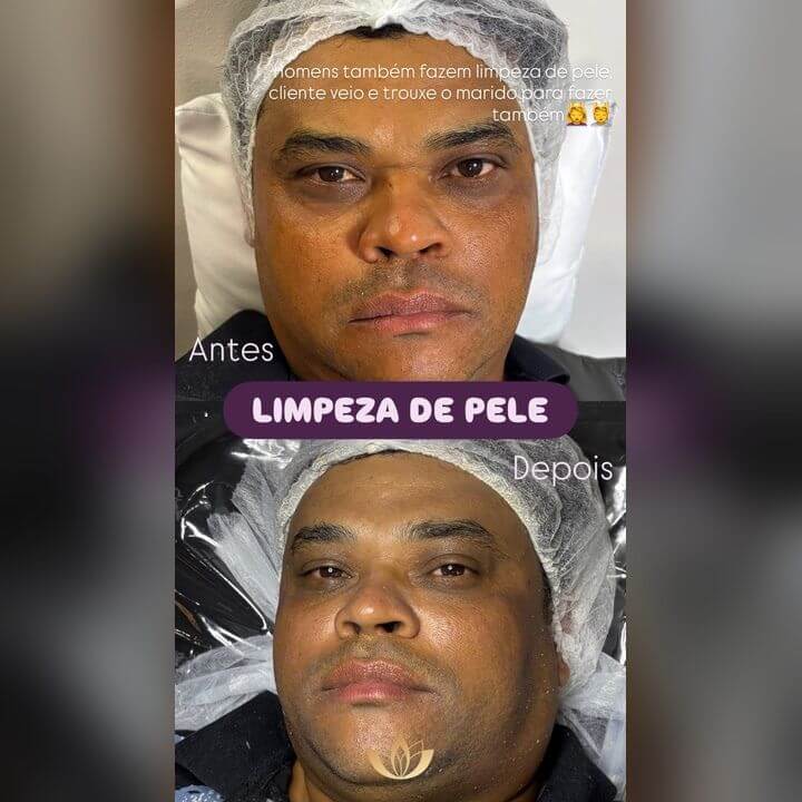 Antes, durante e depois de limpeza de pele masculina