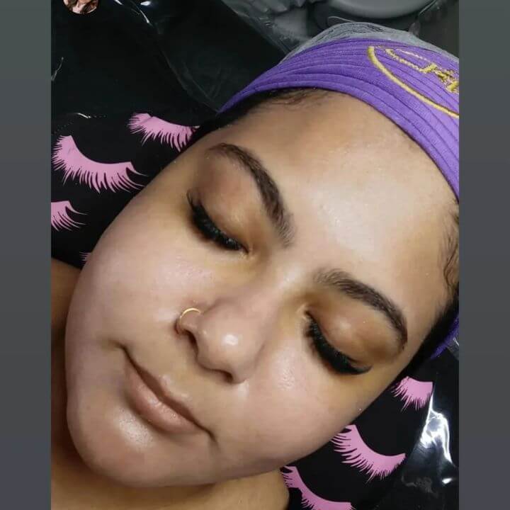 Antes e depois de limpeza de pele facial