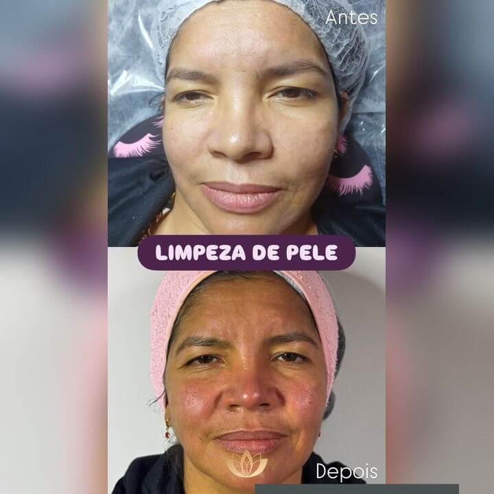 Antes e depois de limpeza de pele no Studio Flávia Demétrio Estética e Bem Estar