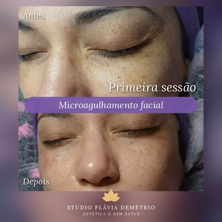 Antes e depois de microagulhamento facial em Paulicéia – resultado 1