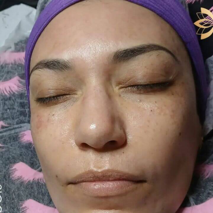 Cliente em sessão de microagulhamento facial no Studio Flávia Demétrio Estética e Bem Estar