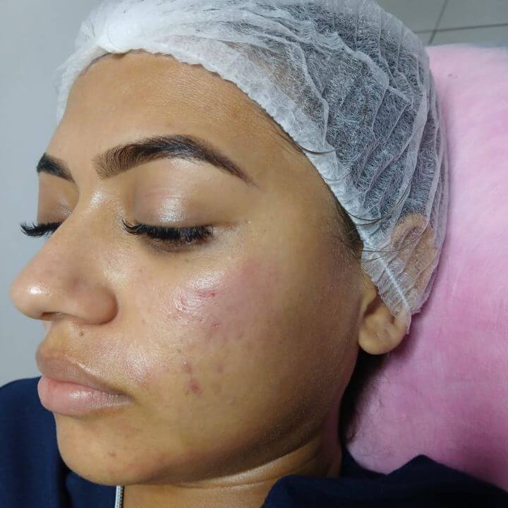 Avaliação da pele antes do microagulhamento facial