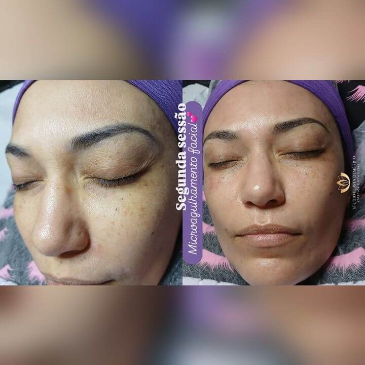 Antes e depois de microagulhamento facial em Paulicéia – resultado 2