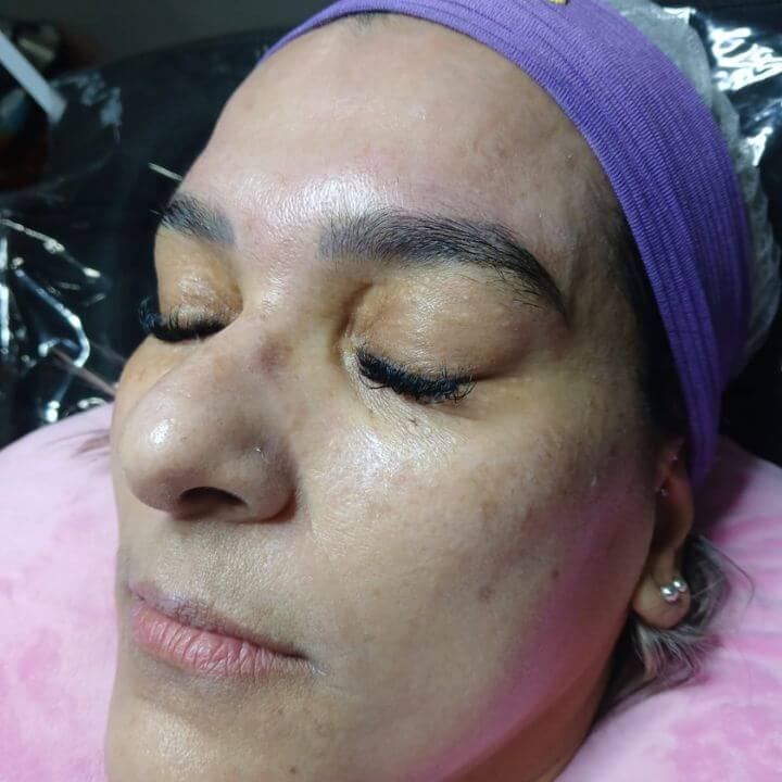Procedimento de microagulhamento facial em Paulicéia